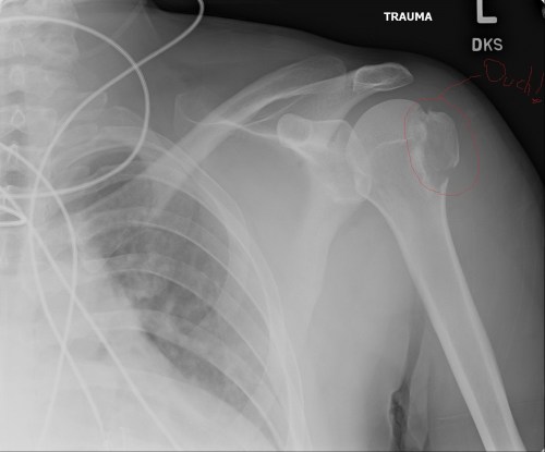 Left shoulder, with the offending greater tubercle/tuberosity of the humerus showing fracture(s).