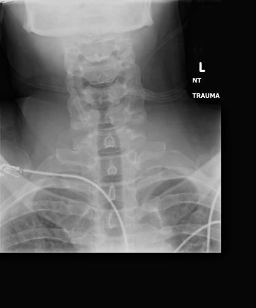 X-ray: No broken neck. This is good.