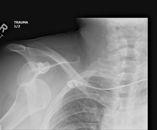 Right shoulder x-ray, showing dislocation of the head of the humerus from the glenoid. Compare with above image- humerus has been shifted down. BUT no fractures, yay!