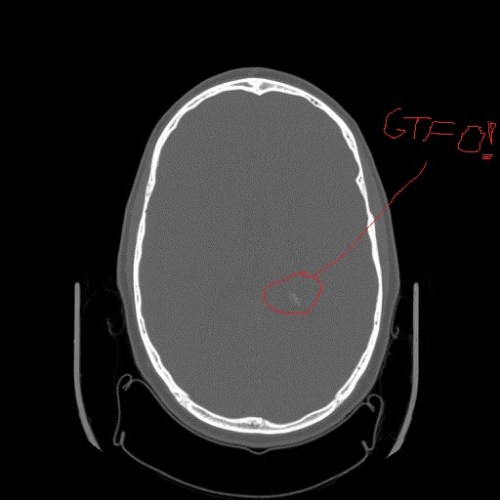 Calcification in ?ventricle? of my cerebrum.