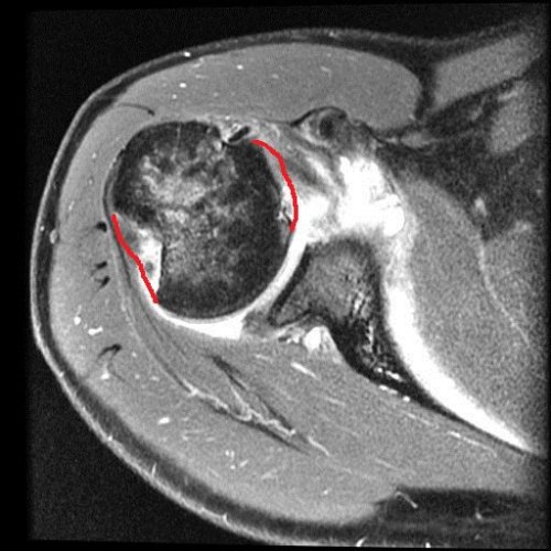 My left shoulder in top cross-sectional view, with the missing parts of my humeral head crudely outlined in red. There's more amiss here, too.