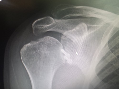 X-ray of my right shoulder from frontal view, unlabelled